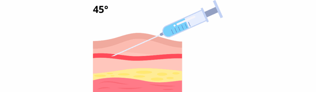 Injections sous-cutanĂ©e et Intramusculaire injection sous cutaneÌe